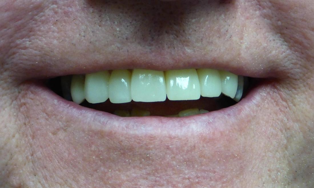 Cosmetic Veneers in Grapevine TX | After