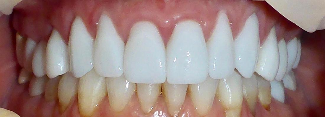 Cosmetic Dentistry Patient in Grapevine TX