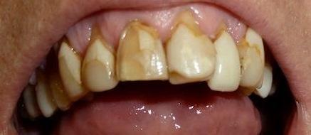Smile Transformation in Grapevine TX | Before