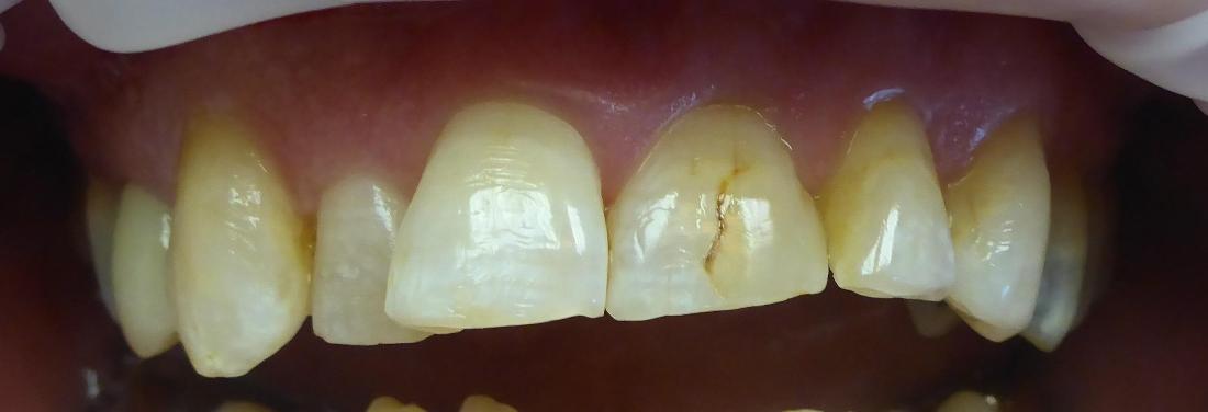 Smile Transformation in Grapevine TX | Before