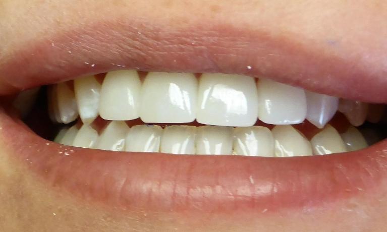 Teeth Repair Smile Gallery