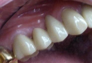 Bridge Replacement in Grapevine TX | After