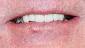 Smile Makeover in Grapevine TX | After