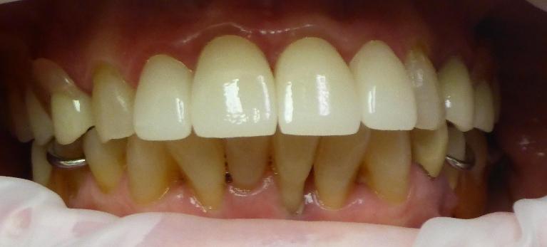 Cosmetic Dentistry in Grapevine TX | After