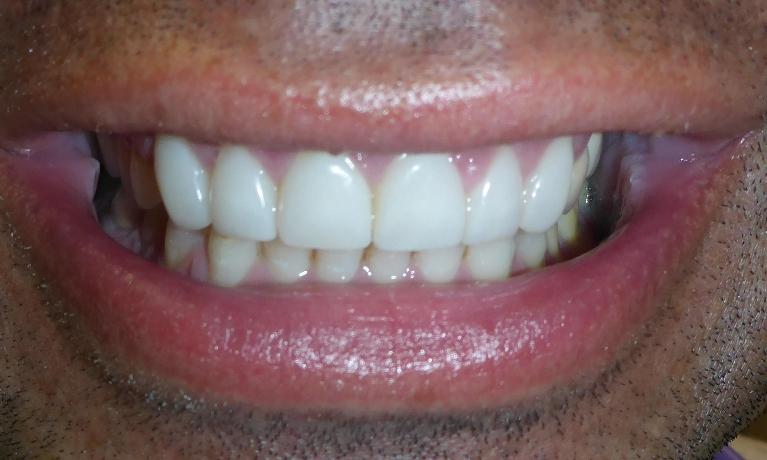 Cosmetic Dentistry in Grapevine TX | After