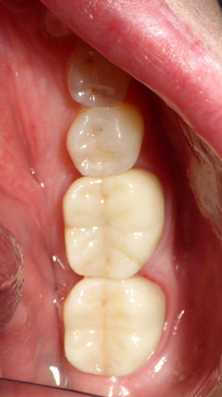 Crowns-After-Image