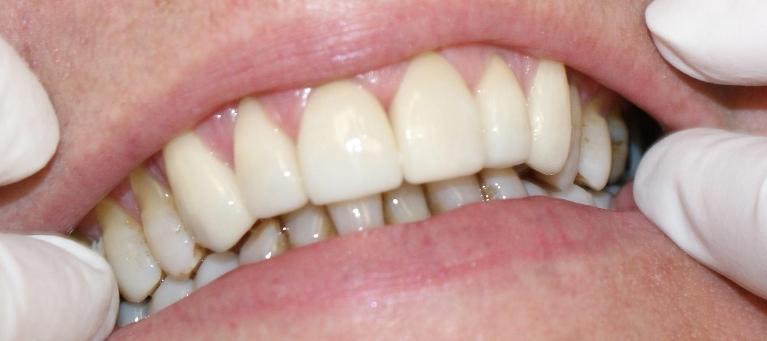 Smile-Transformation-After-Image