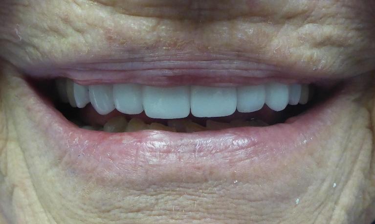 Smile Transformation in Grapevine TX | After