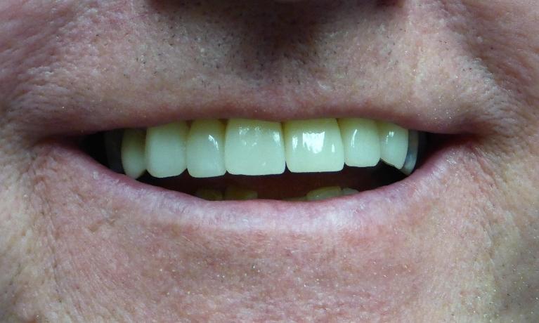 Cosmetic Veneers in Grapevine TX | After