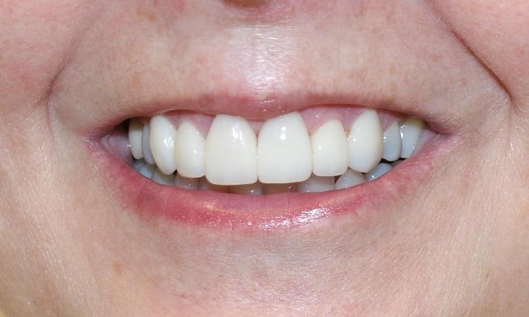Veneers-After-Image