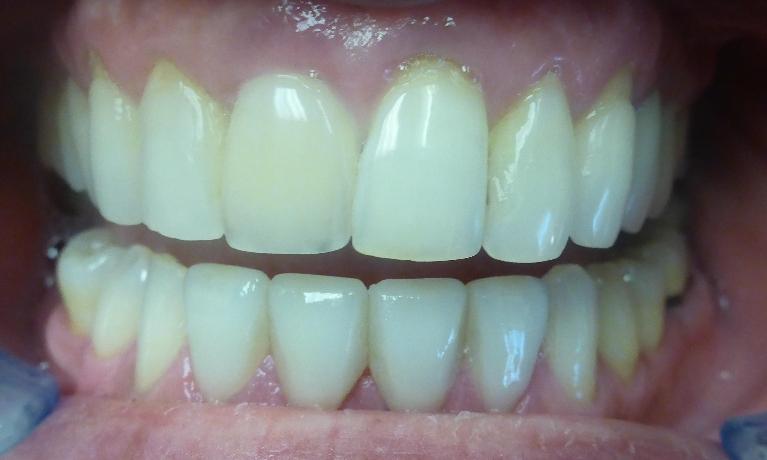 Smile Transformation in Grapevine TX | After