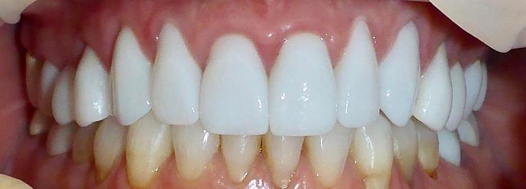 Patient-was-Unhappy-With-Previous-Cosmetic-Dentistry-Top-After-Image