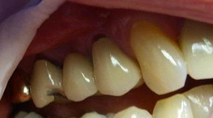 Bridge Replacement in Grapevine TX | Before