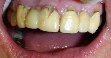 Smile Transformation in Grapevine TX | Before