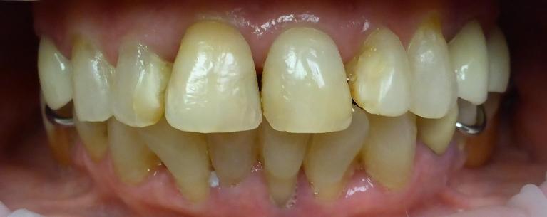 Smile Transformation in Grapevine TX | Before