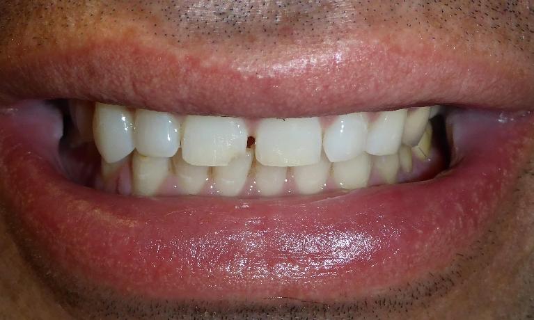 Smile Transformation in Grapevine TX | Before