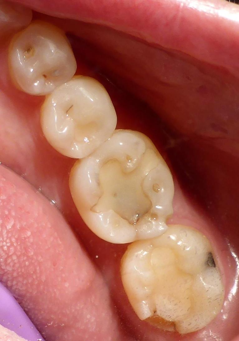 Crowns-Before-Image