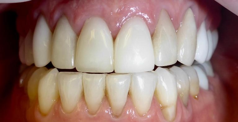 Patient-was-Unhappy-With-Previous-Cosmetic-Dentistry-Top-Before-Image