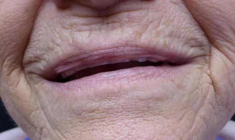 Smile Transformation in Grapevine TX | Before