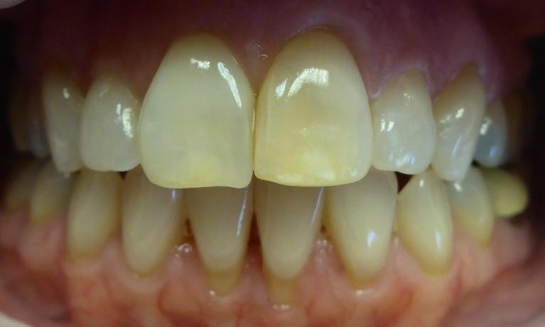 Veneers-Before-Image