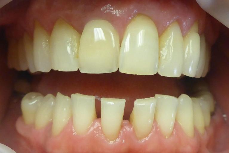 Smile Transformation in Grapevine TX | Before
